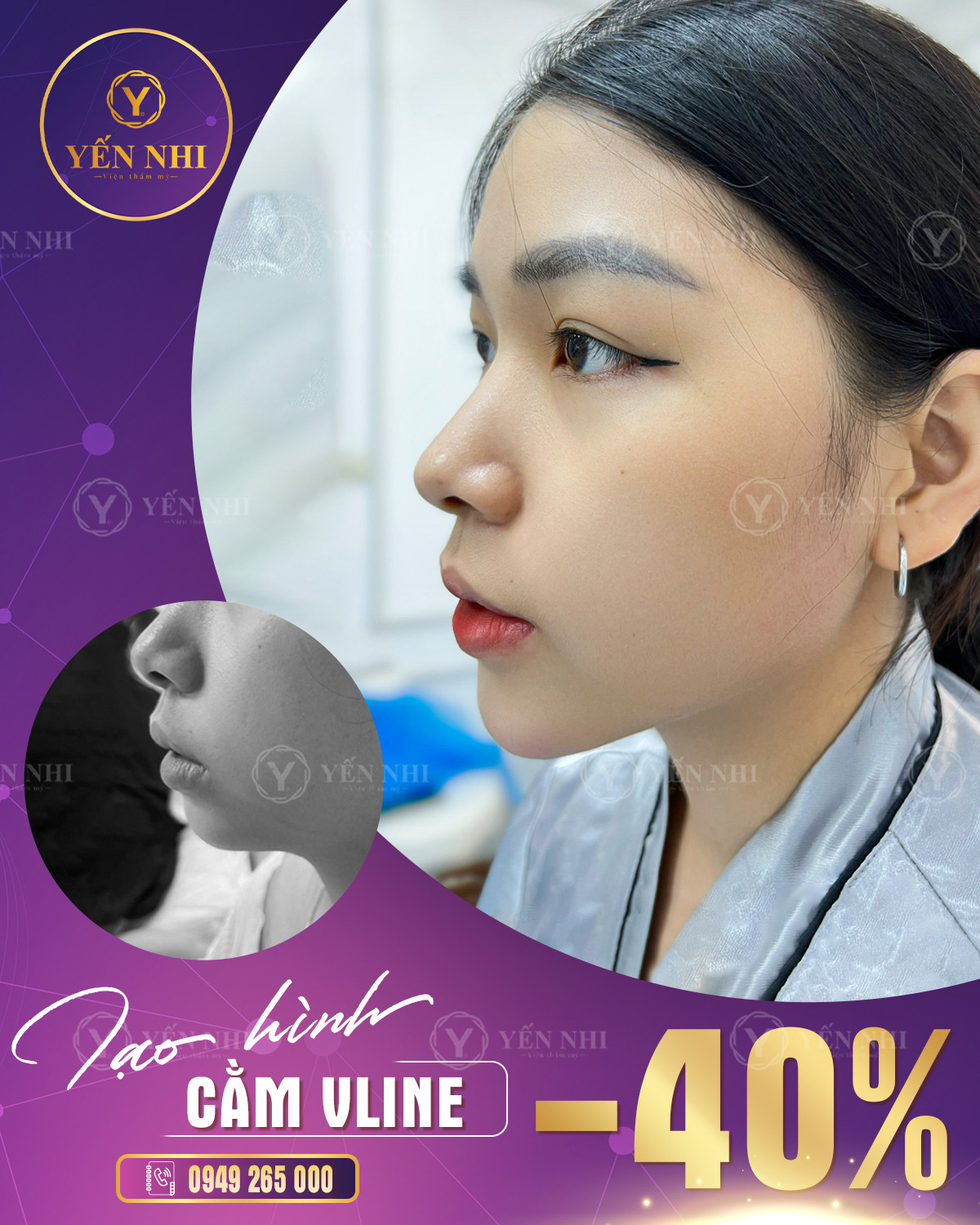 tiêm filler cằm vline