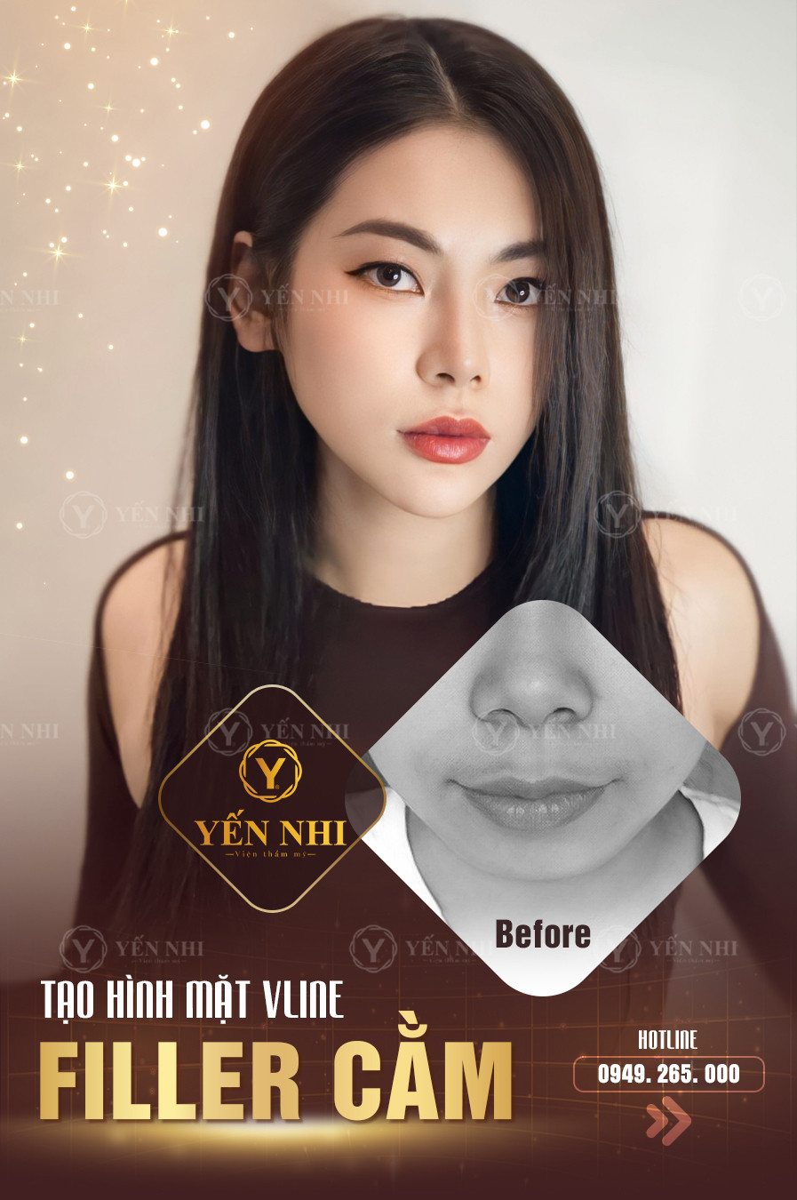 tiêm filler cằm