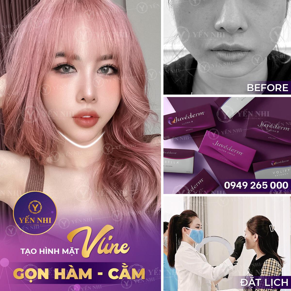 tiêm filler cằm vline