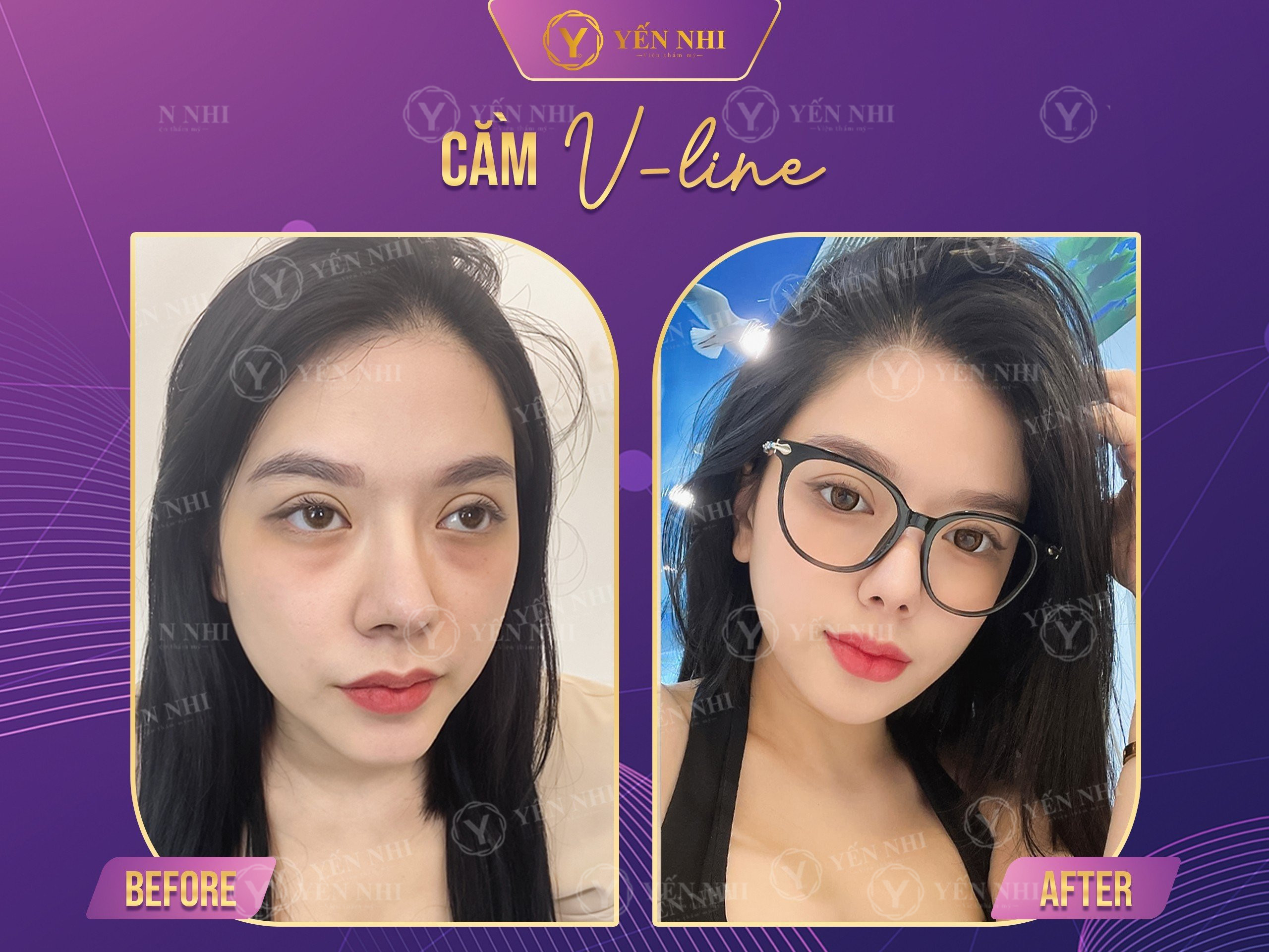 tiêm filler cằm vline