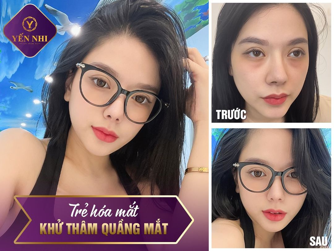 khử thâm mắt 2