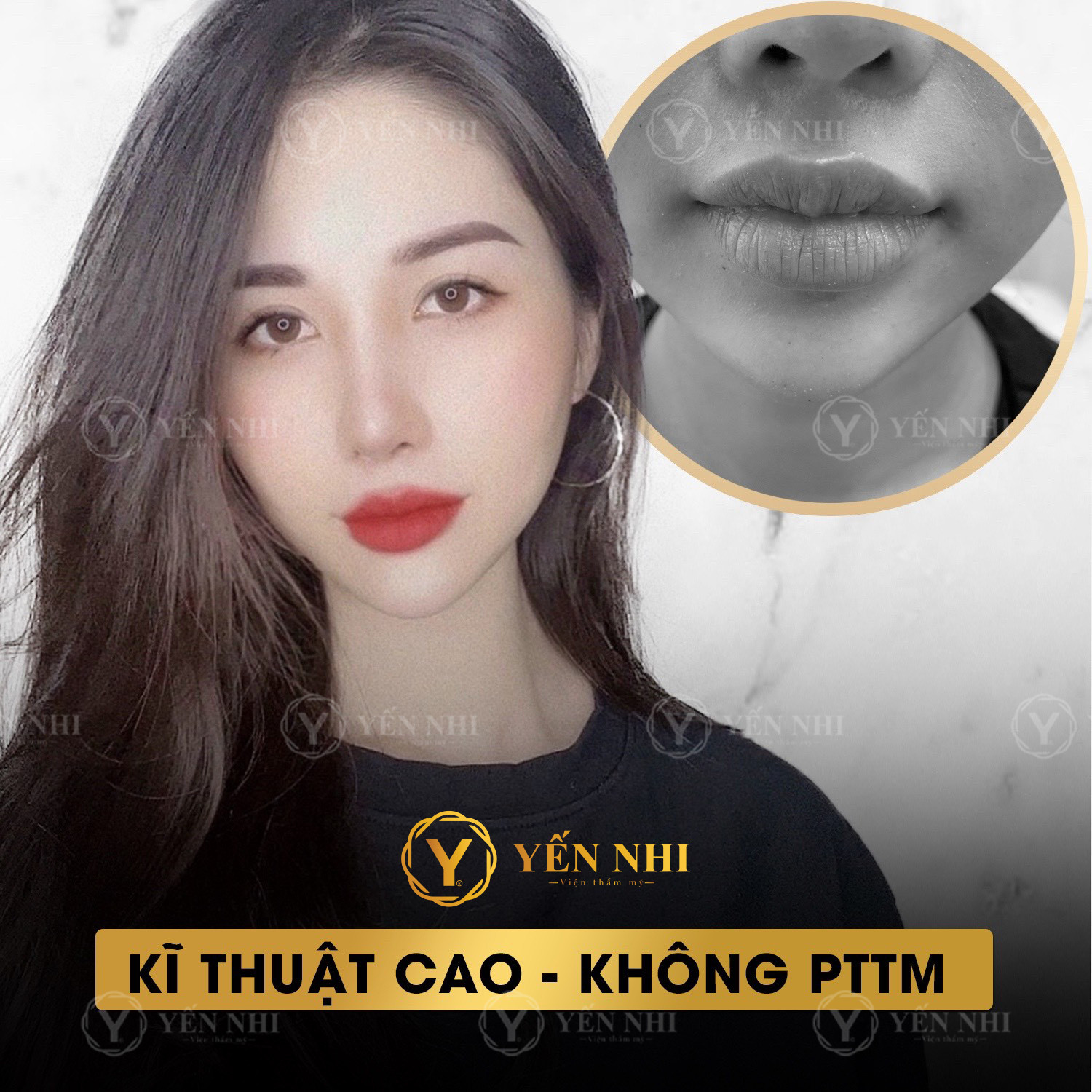 Công nghệ V-line Perfect là gì?