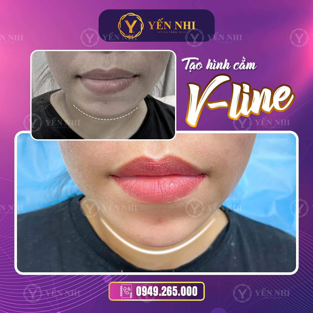 tiêm filler cằm