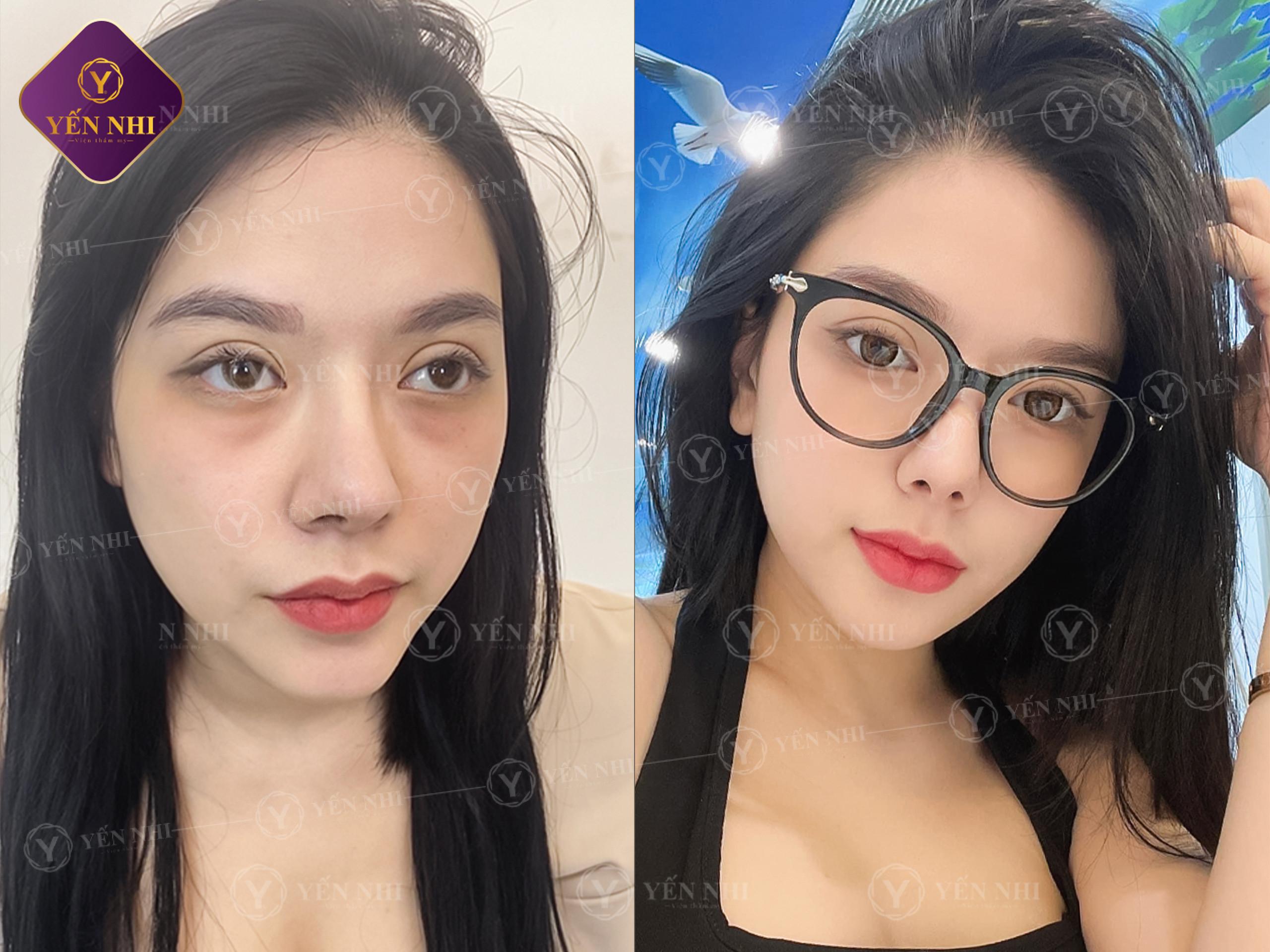 tiêm botox gọn hàm