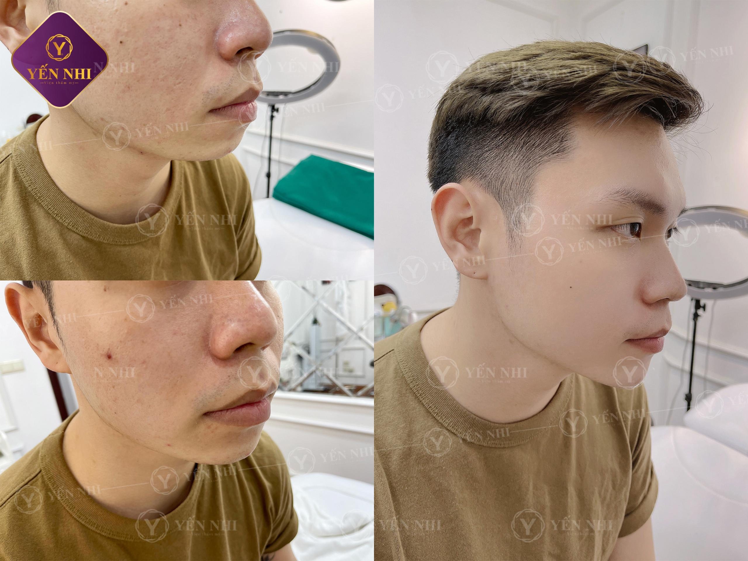 tiêm botox gọn hàm có hại không?