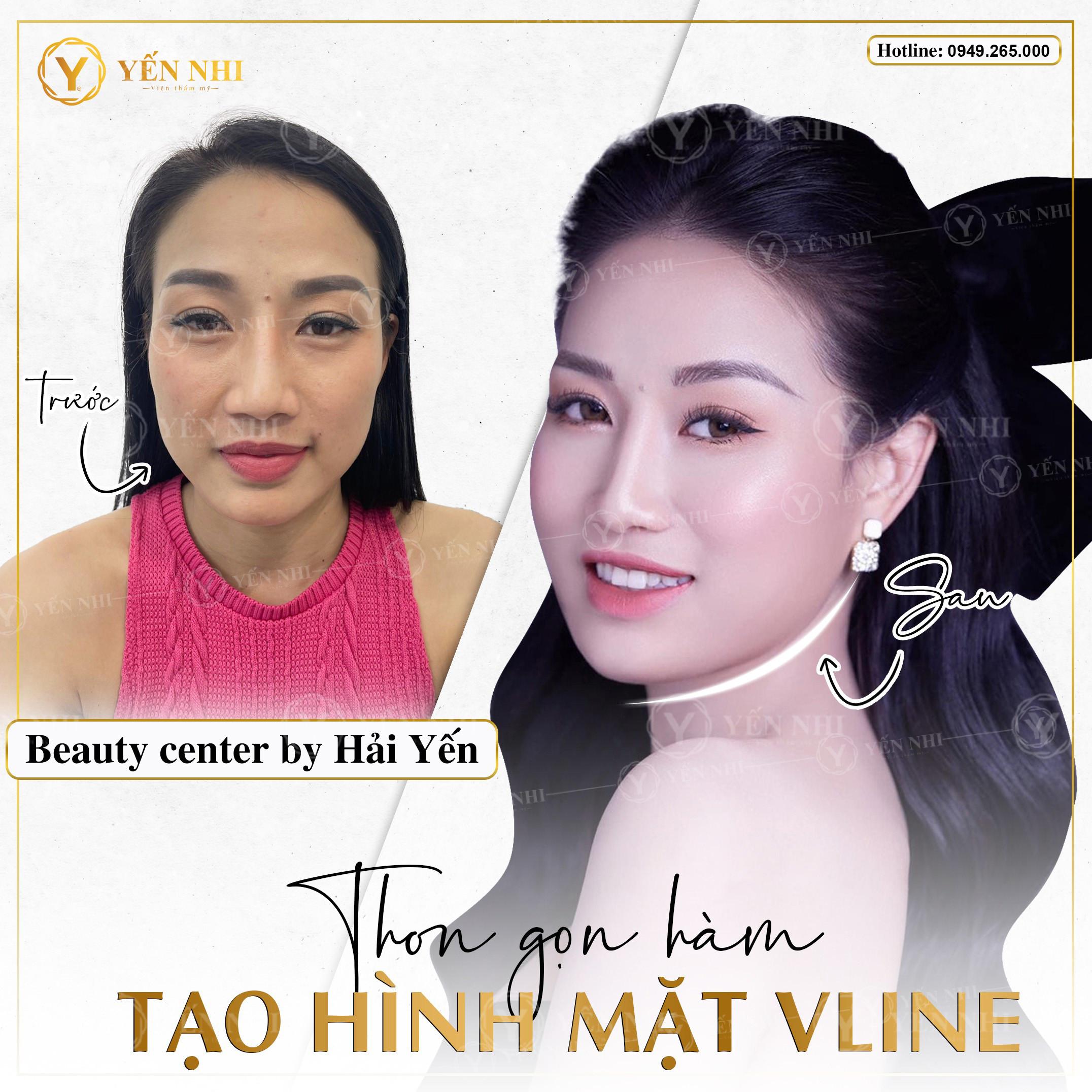 tiem botox gọn hàm