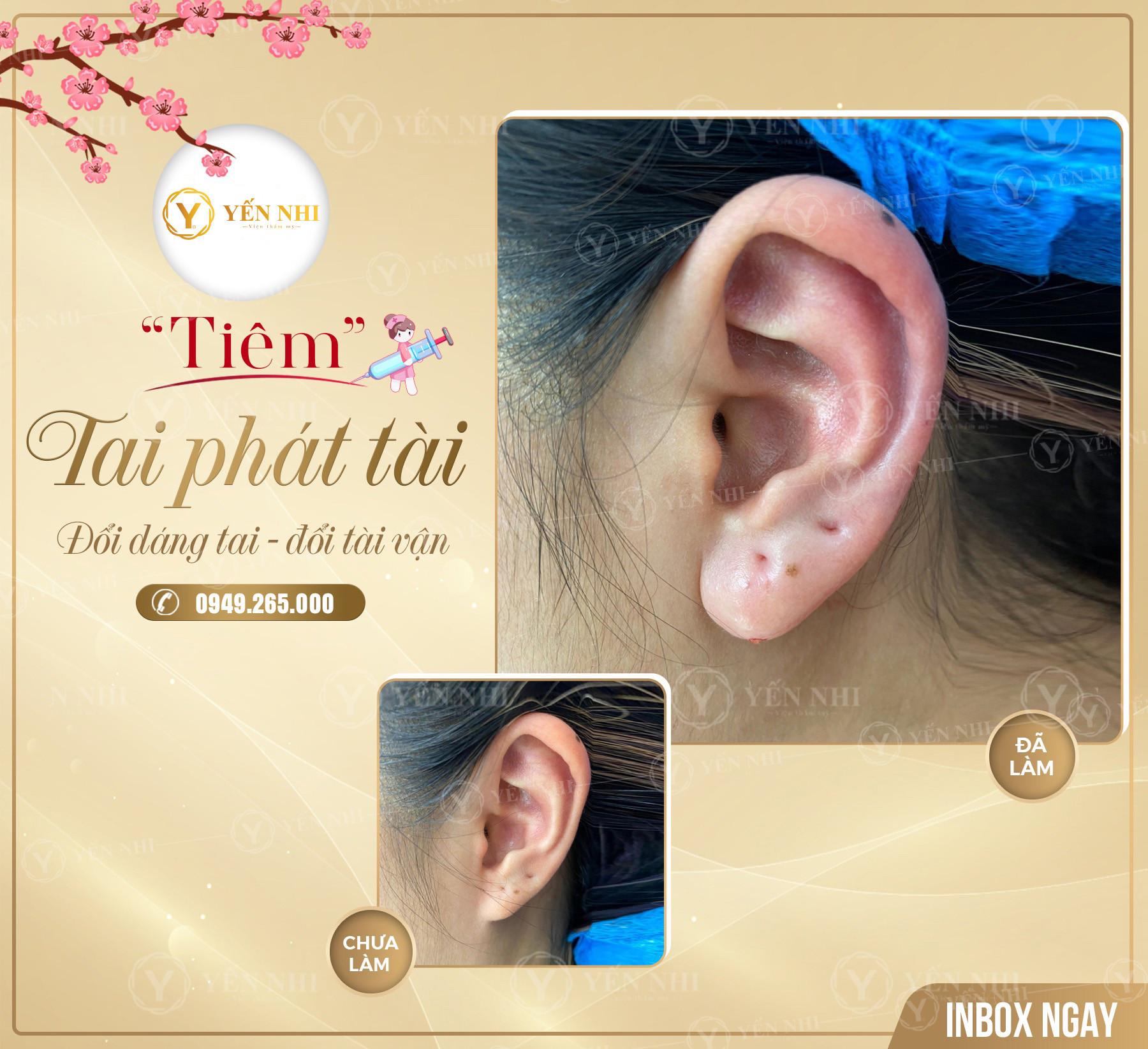 TIÊM FILLER TAI TÀI LỘC LÀ NHƯ THẾ NÀO?