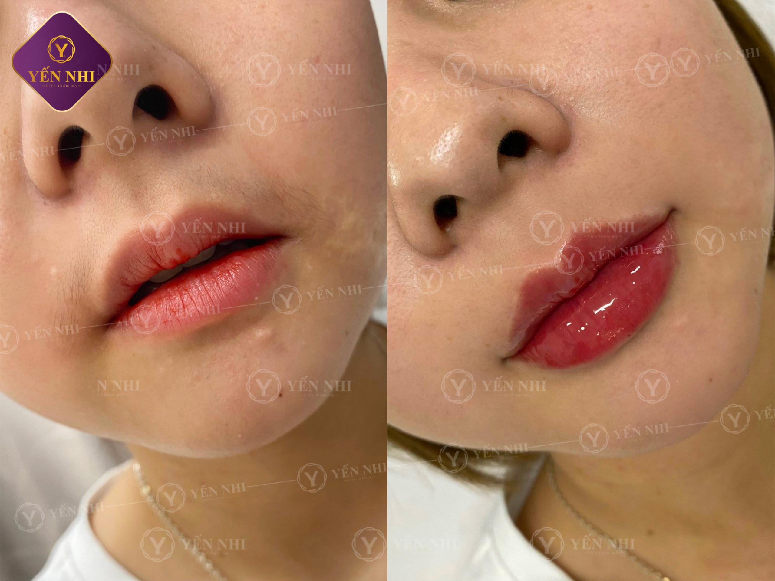 tiêm filler môi cười