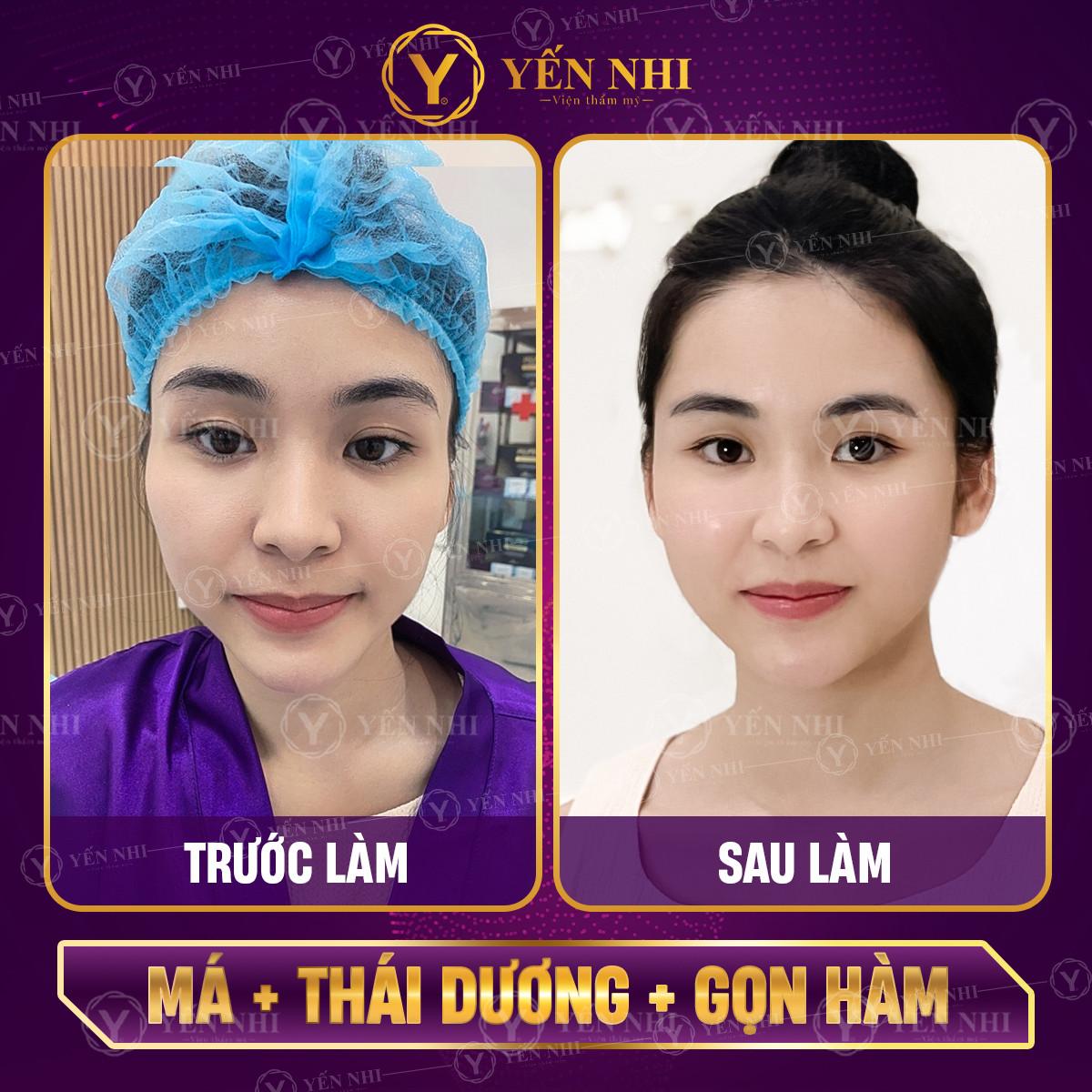 tiêm tan filler có tốt không?