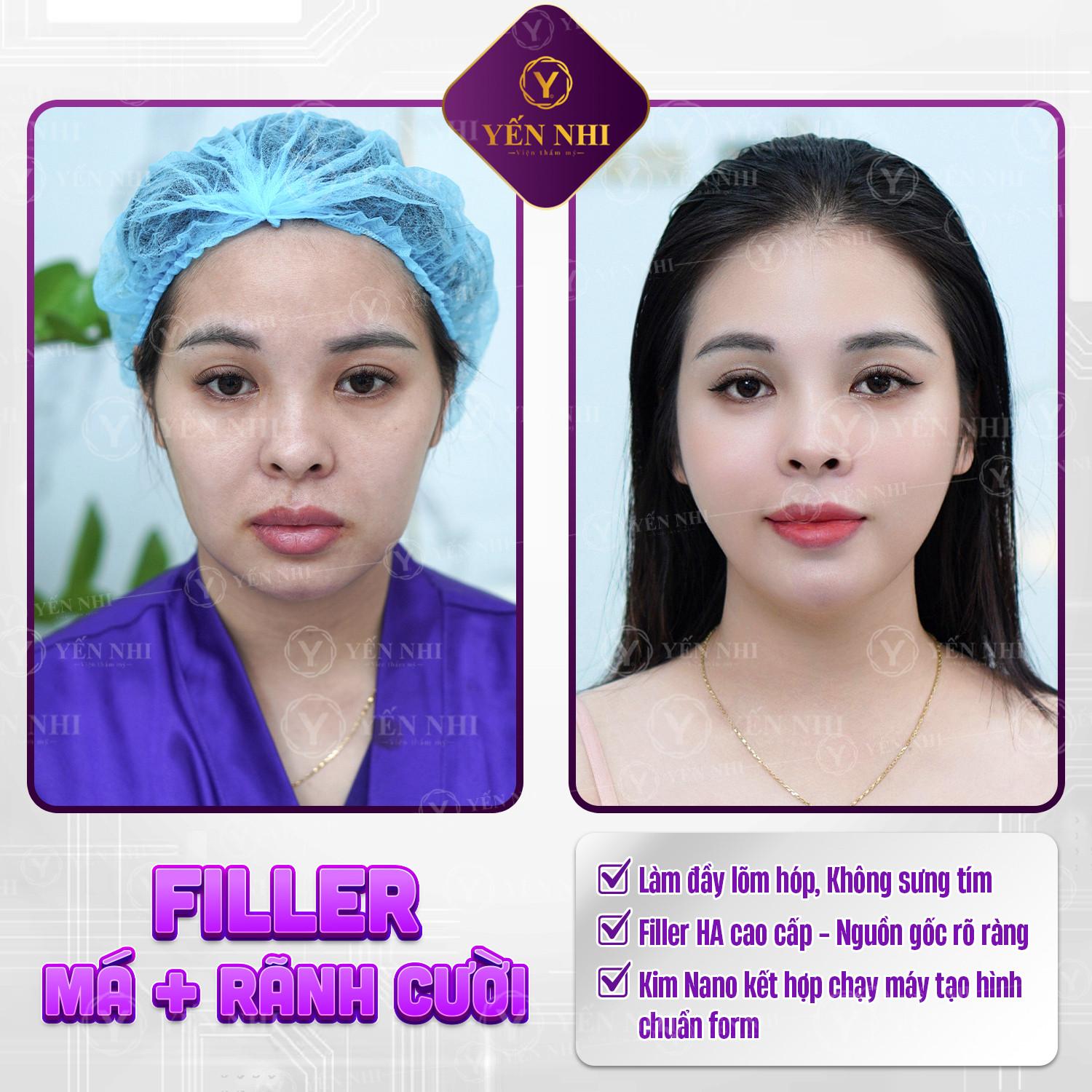 lưu ý sau khi tiêm tan filler