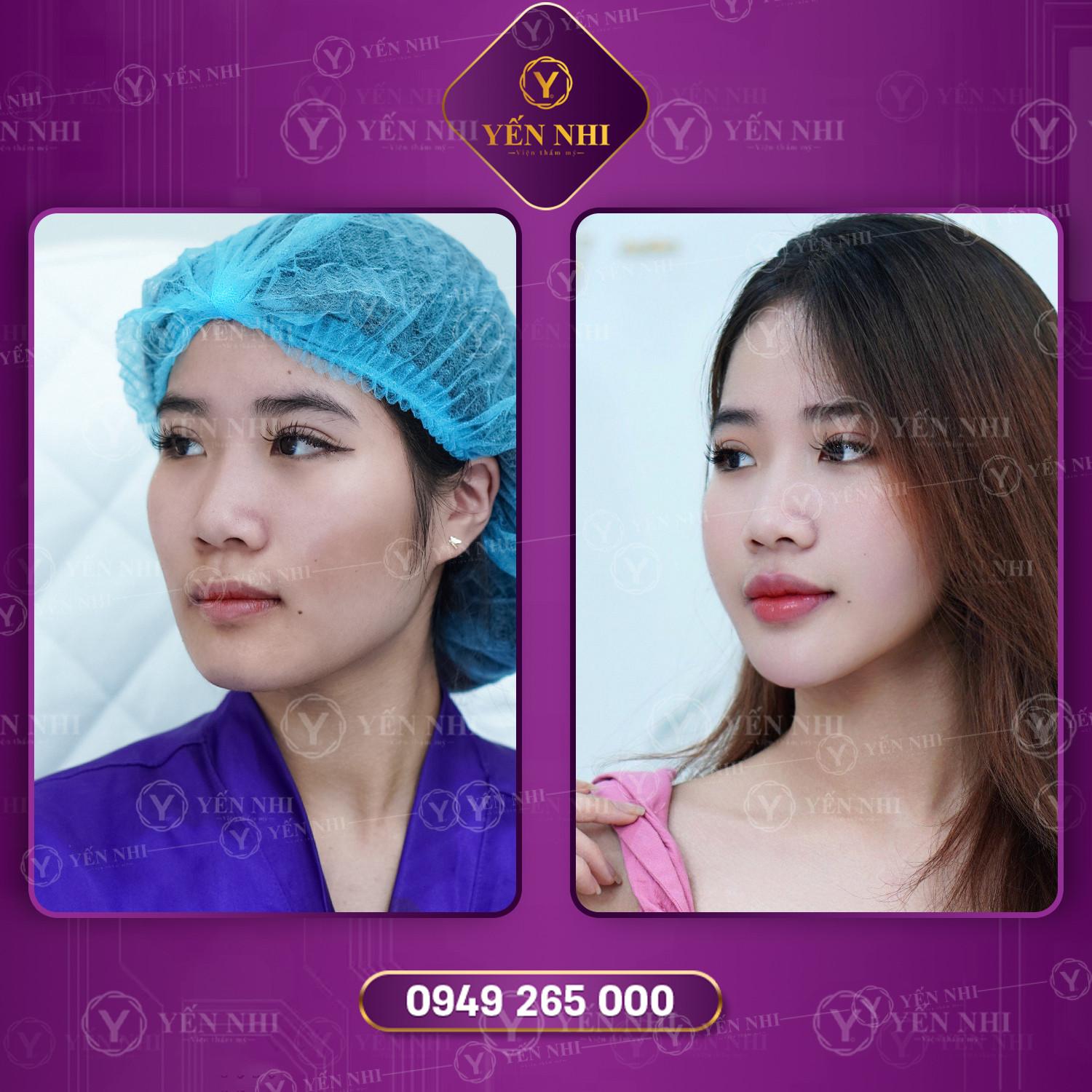 tiêm filler và những lưu ý