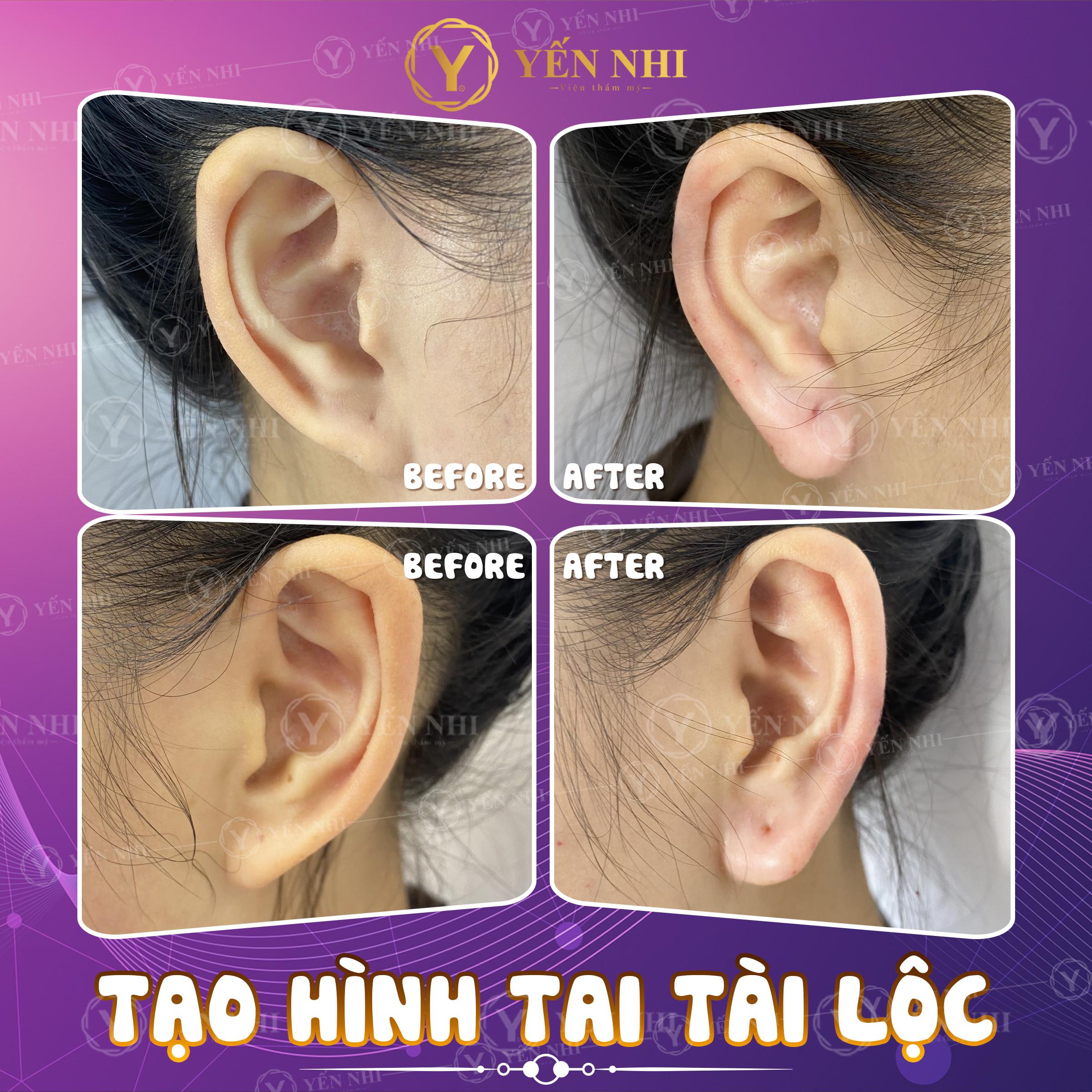 TIÊM FILLER TAI TÀI LỘC CÓ GIÁ BAO NHIÊU?