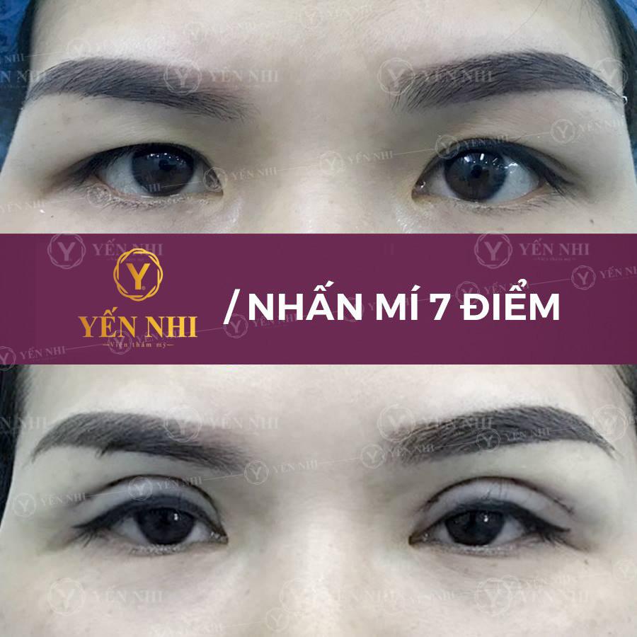 dịch vụ nhấn mí là gì?