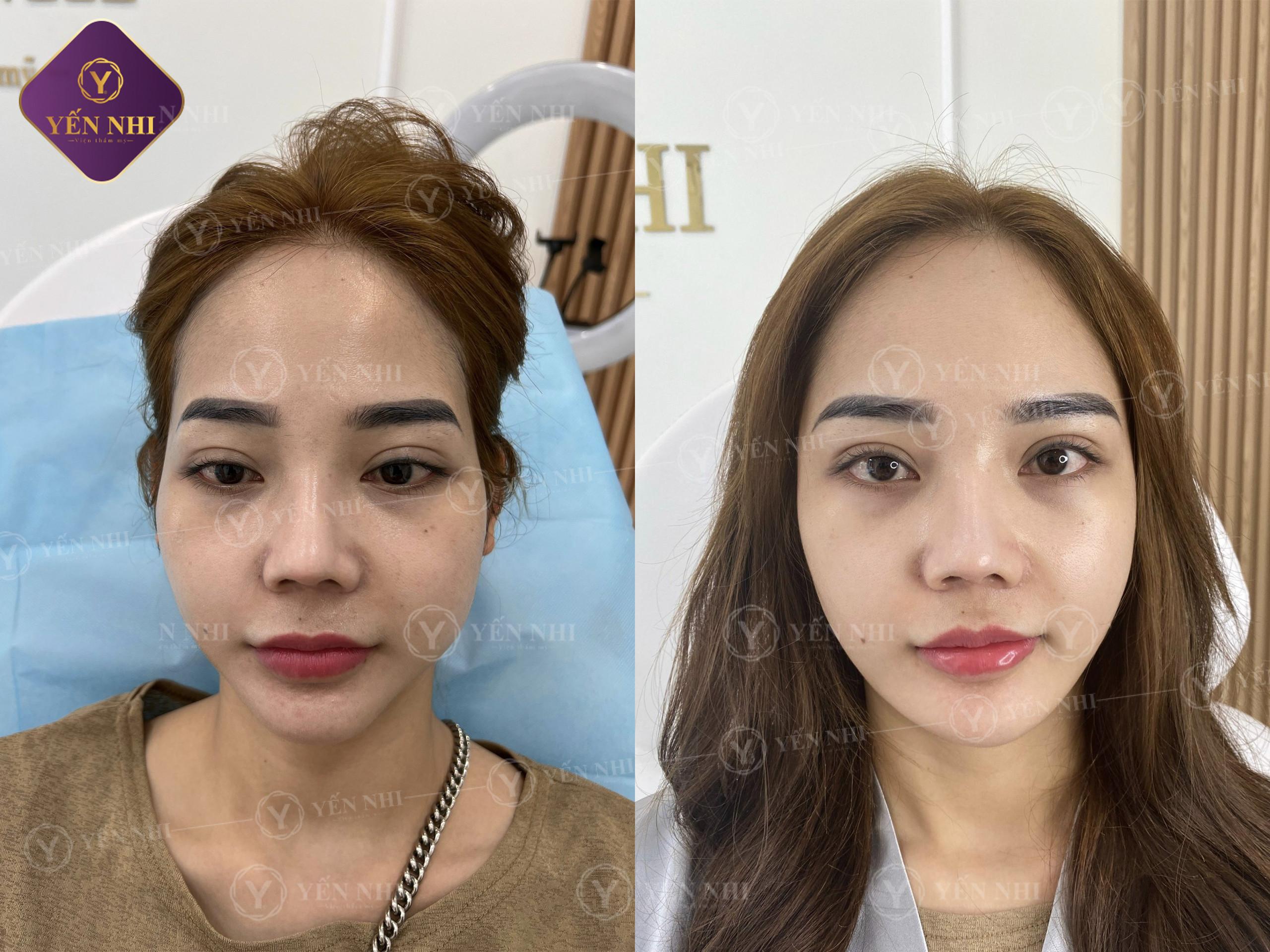 ưu điểm của tiêm filler thái dương