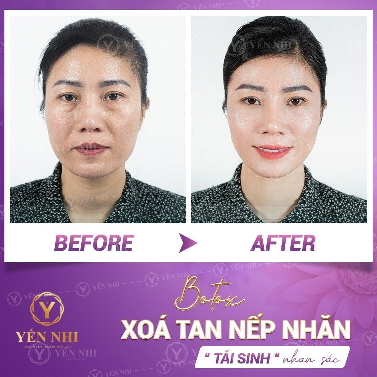 Đặc điểm tương tự nhau giữa tiêm filler botox