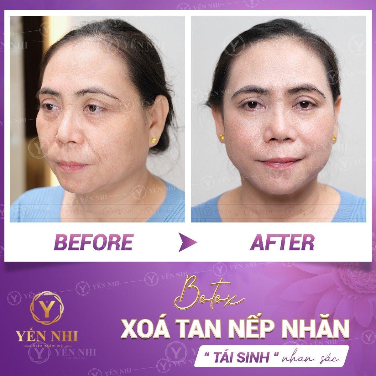 Tiêm botox bao lâu thì tiêm lại?