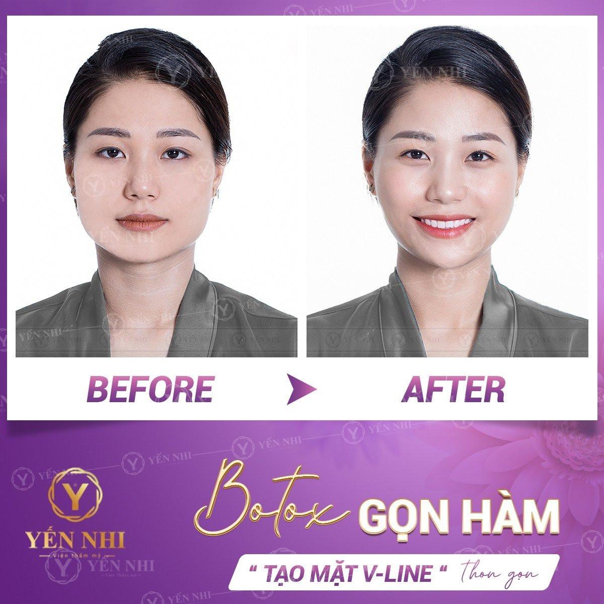 Tiêm botox có hại không? Tiêm botox có an toàn không?