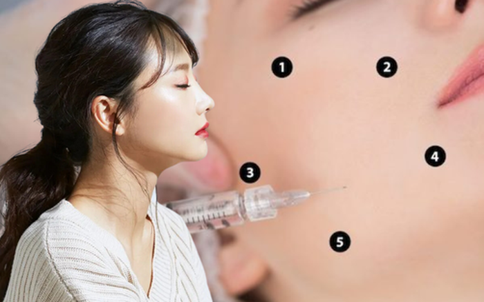 KỸ THUẬT TIÊM BAP 5 ĐIỂM - PHƯƠNG PHÁP TRẺ HOÁ CĂNG BÓNG ĐƯỢC ƯA CHUỘNG HIỆN NAY