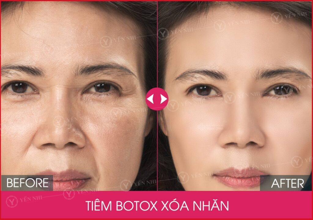 Lấy Lại Thanh Xuân Nhờ Tiêm Botox Xoá Nhăn