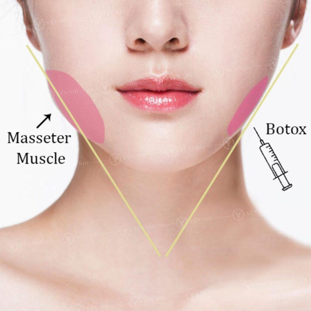 Tiêm Botox Xóa Nếp Nhăn - Giải Pháp Trẻ Hóa Làn Da Hiệu Quả