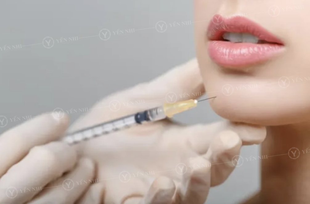 Tiêm Filler Cằm: Giải Pháp Tạo Dáng Cằm Đẹp Tự Nhiên Tại Viện Thẩm Mỹ Yến Nhi